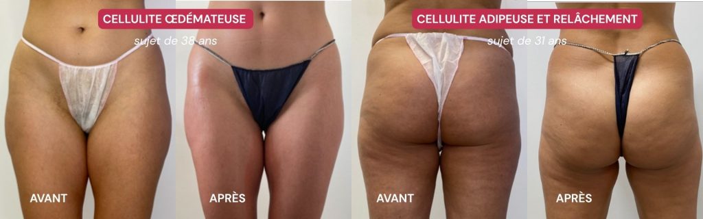 Traitement minceur en cabine bodyshock