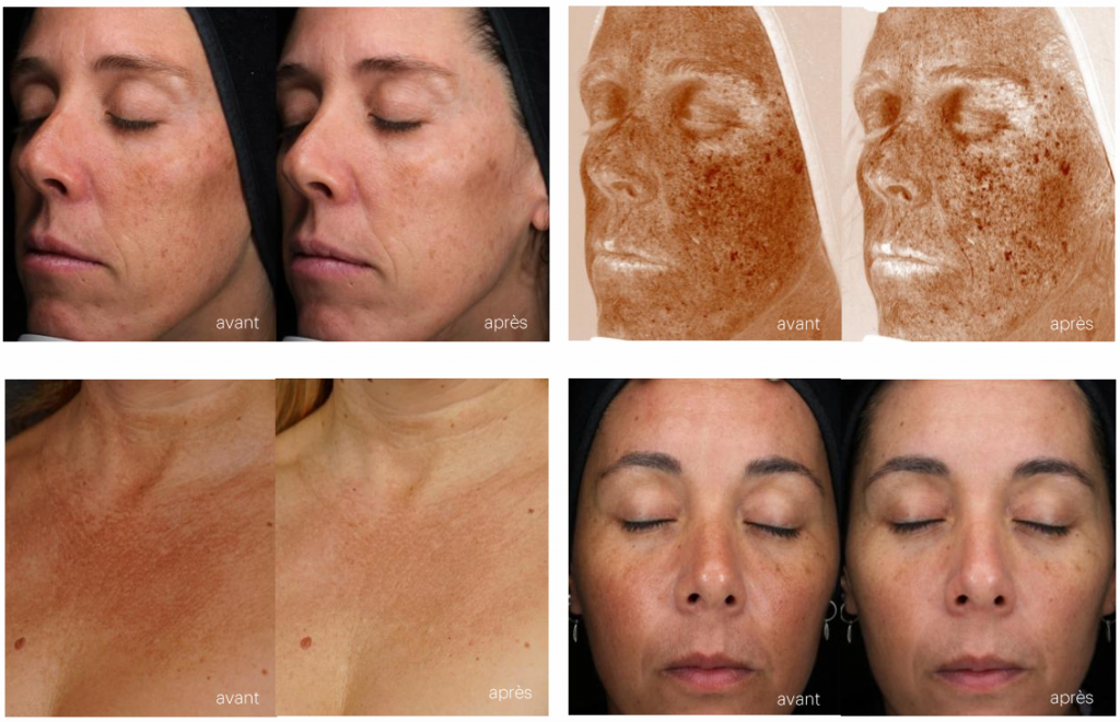 Résultats avant/après c.prof 218 depigmentation solution